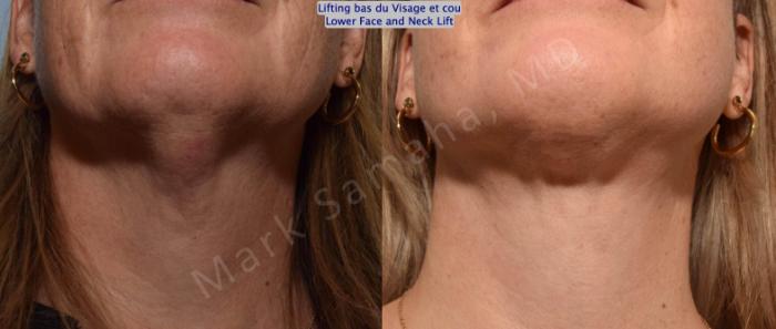 Before & After Lifting du visage / Cou - Facelift / Necklift Case 160 Neck / Cou View in Montreal, QC