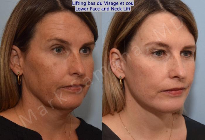 Before & After Lifting du visage / Cou - Facelift / Necklift Case 160 Right Oblique View in Montreal, QC
