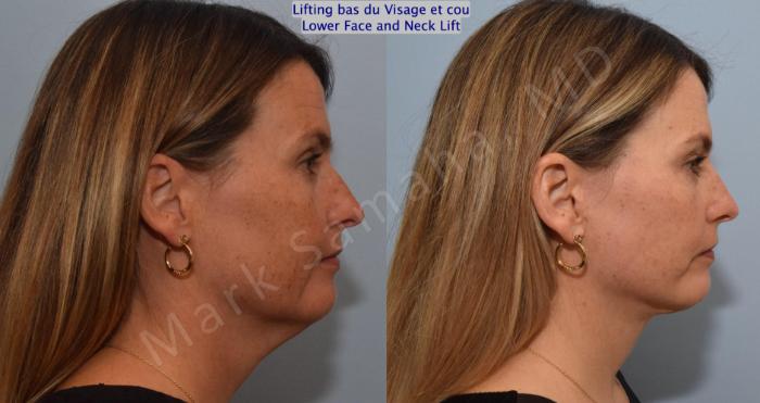 Before & After Lifting du visage / Cou - Facelift / Necklift Case 160 Right Side View in Montreal, QC