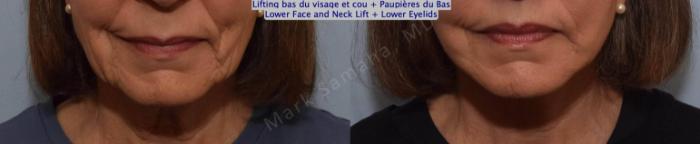 Before & After Lifting du visage / Cou - Facelift / Necklift Case 162 Front View in Mount Royal, QC