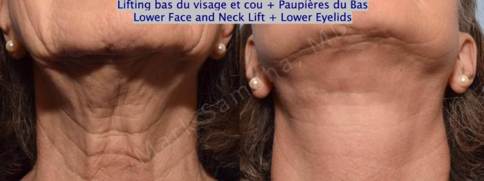 Before & After Lifting du visage / Cou - Facelift / Necklift Case 162 Neck / Cou View in Montreal, QC