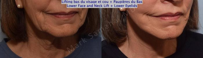 Before & After Lifting du visage / Cou - Facelift / Necklift Case 162 Right Oblique View in Mount Royal, QC