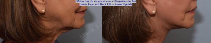 Before & After Lifting du visage / Cou - Facelift / Necklift Case 162 Right Side View in Mount Royal, QC