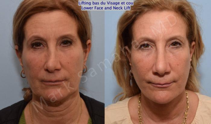 Before & After Lifting du visage / Cou - Facelift / Necklift Case 163 Front View in Montreal, QC
