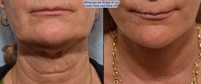 Before & After Lifting du visage / Cou - Facelift / Necklift Case 163 Neck / Cou View in Montreal, QC