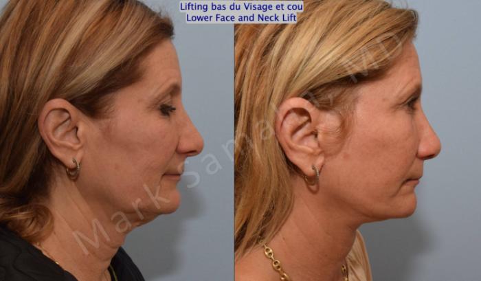 Before & After Lifting du visage / Cou - Facelift / Necklift Case 163 Right Side View in Mount Royal, QC