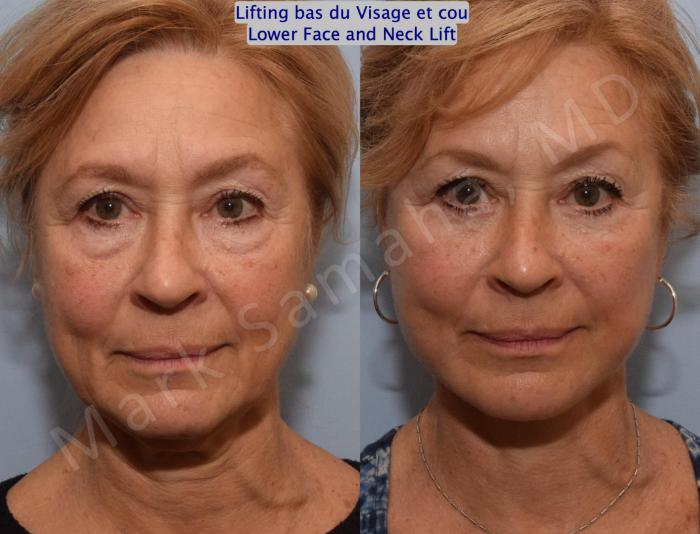 Before & After Lifting du visage / Cou - Facelift / Necklift Case 164 Front View in Montreal, QC