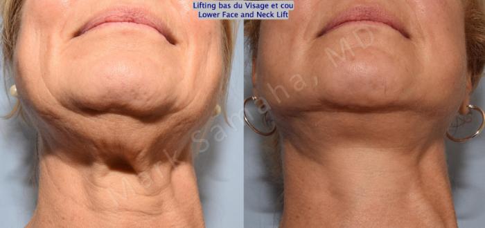 Before & After Lifting du visage / Cou - Facelift / Necklift Case 164 Neck / Cou View in Montreal, QC