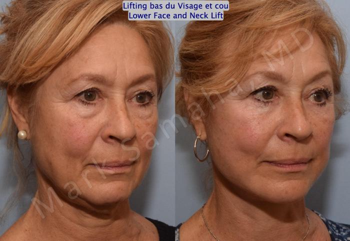 Before & After Lifting du visage / Cou - Facelift / Necklift Case 164 Right Oblique View in Montreal, QC
