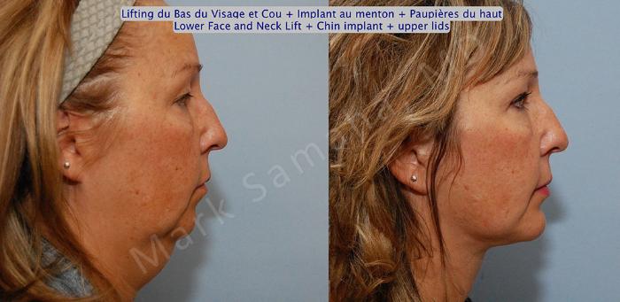 Before & After Lifting du visage / Cou - Facelift / Necklift Case 17 View #5 View in Mount Royal, QC