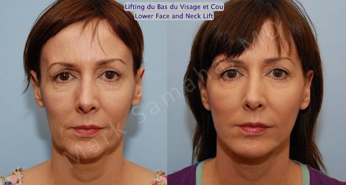 Before & After Lifting du visage / Cou - Facelift / Necklift Case 18 View #1 View in Montreal, QC