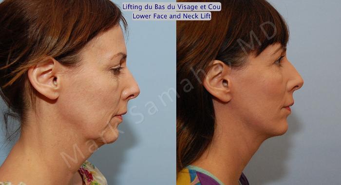 Before & After Lifting du visage / Cou - Facelift / Necklift Case 18 View #5 View in Montreal, QC