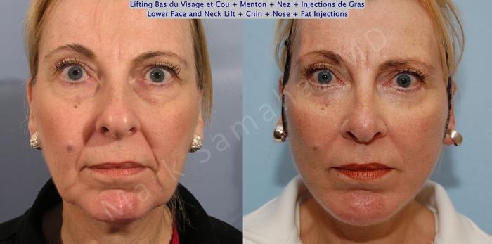 Before & After Lifting du visage / Cou - Facelift / Necklift Case 19 View #2 View in Mount Royal, QC