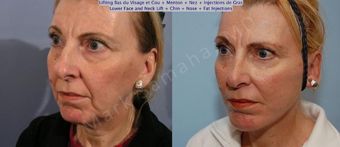Before & After Lifting du visage / Cou - Facelift / Necklift Case 19 View #3 View in Mount Royal, QC