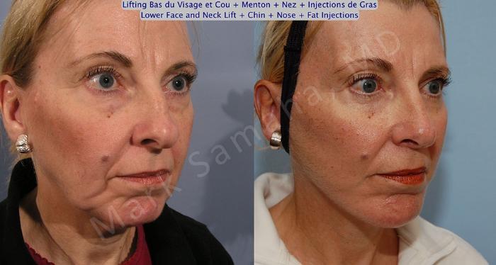 Before & After Lifting du visage / Cou - Facelift / Necklift Case 19 View #4 View in Mount Royal, QC