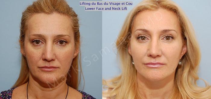 Before & After Lifting du visage / Cou - Facelift / Necklift Case 20 View #1 View in Montreal, QC
