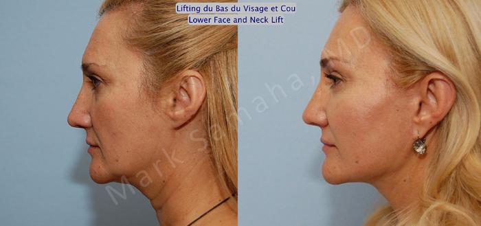 Before & After Lifting du visage / Cou - Facelift / Necklift Case 20 View #2 View in Montreal, QC