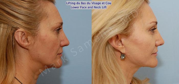 Before & After Lifting du visage / Cou - Facelift / Necklift Case 20 View #5 View in Mount Royal, QC