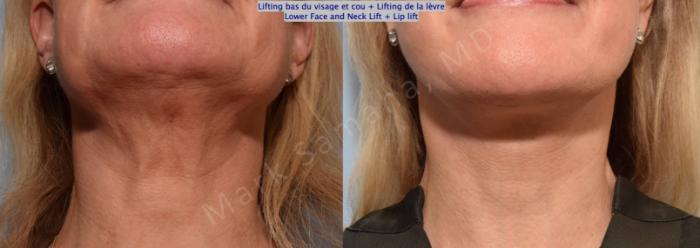 Before & After Lifting du visage / Cou - Facelift / Necklift Case 202 Basal View in Montreal, QC