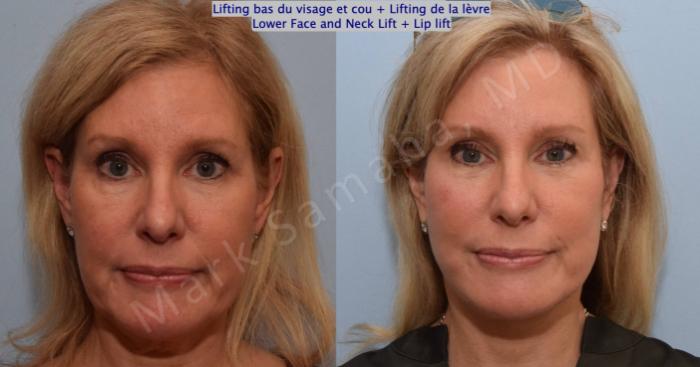 Before & After Lifting du visage / Cou - Facelift / Necklift Case 202 Front View in Montreal, QC