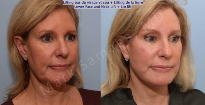 Before & After Lifting du visage / Cou - Facelift / Necklift Case 202 Right Oblique View in Montreal, QC