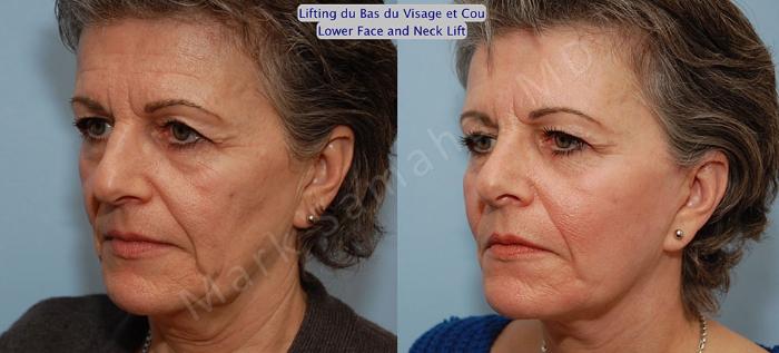Before & After Lifting du visage / Cou - Facelift / Necklift Case 21 View #2 View in Montreal, QC