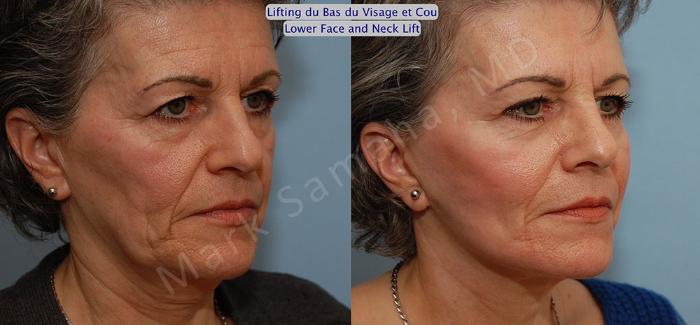 Before & After Lifting du visage / Cou - Facelift / Necklift Case 21 View #3 View in Mount Royal, QC