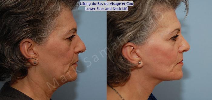 Before & After Lifting du visage / Cou - Facelift / Necklift Case 21 View #4 View in Montreal, QC