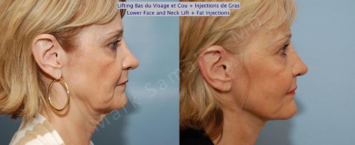 Before & After Lifting du visage / Cou - Facelift / Necklift Case 22 View #5 View in Montreal, QC