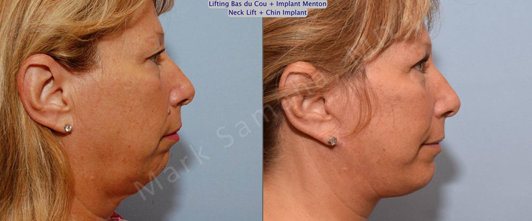 Lifting Du Visage Cou Facelift Necklift Avant And Après Photos