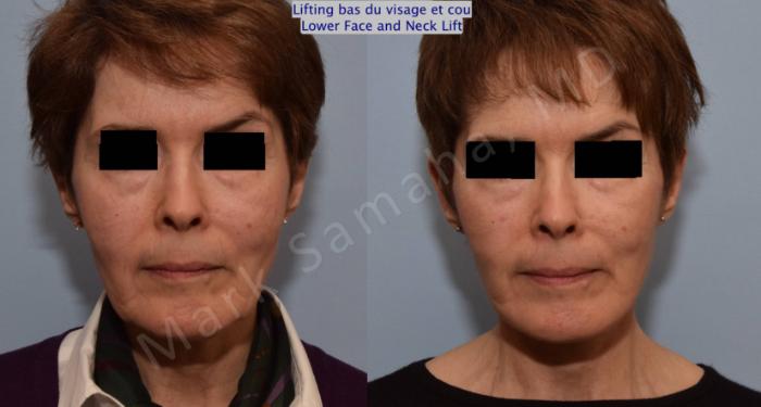 Before & After Lifting du visage / Cou - Facelift / Necklift Case 66 View #1 View in Montreal, QC