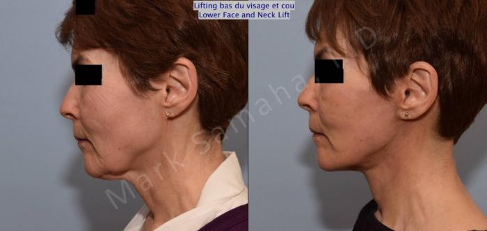 Before & After Lifting du visage / Cou - Facelift / Necklift Case 66 View #2 View in Mount Royal, QC