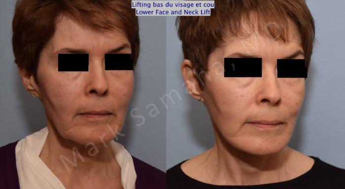 Before & After Lifting du visage / Cou - Facelift / Necklift Case 66 View #5 View in Montreal, QC