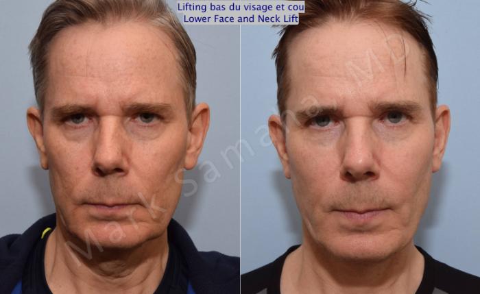 Before & After Lifting du visage / Cou - Facelift / Necklift Case 67 View #1 View in Mount Royal, QC