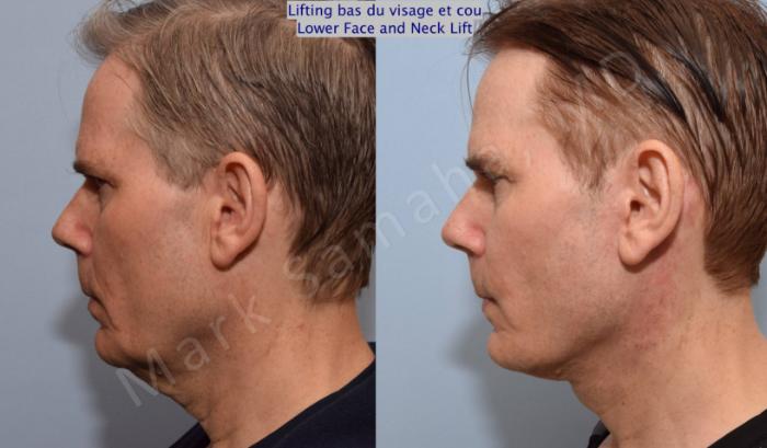 Before & After Lifting du visage / Cou - Facelift / Necklift Case 67 View #2 View in Mount Royal, QC