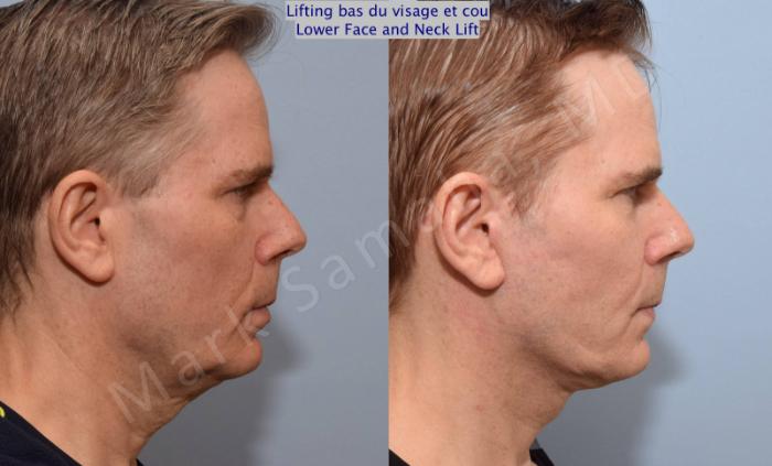 Before & After Lifting du visage / Cou - Facelift / Necklift Case 67 View #3 View in Montreal, QC