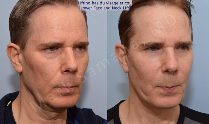 Before & After Lifting du visage / Cou - Facelift / Necklift Case 67 View #5 View in Montreal, QC