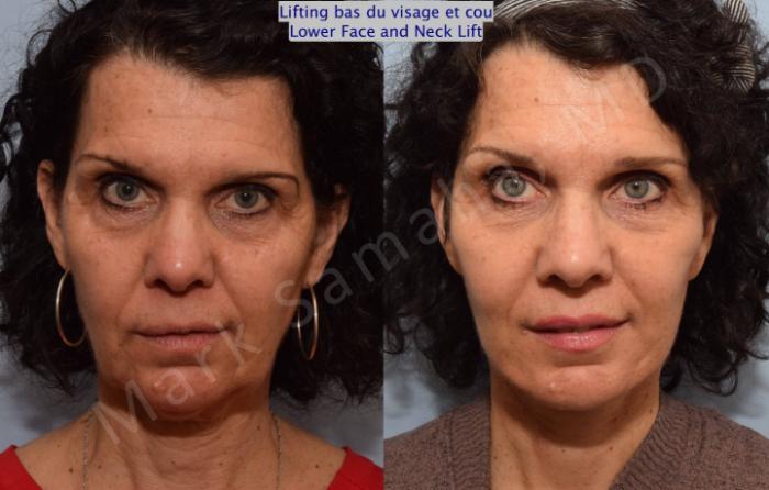 Before & After Lifting du visage / Cou - Facelift / Necklift Case 68 View #1 View in Montreal, QC