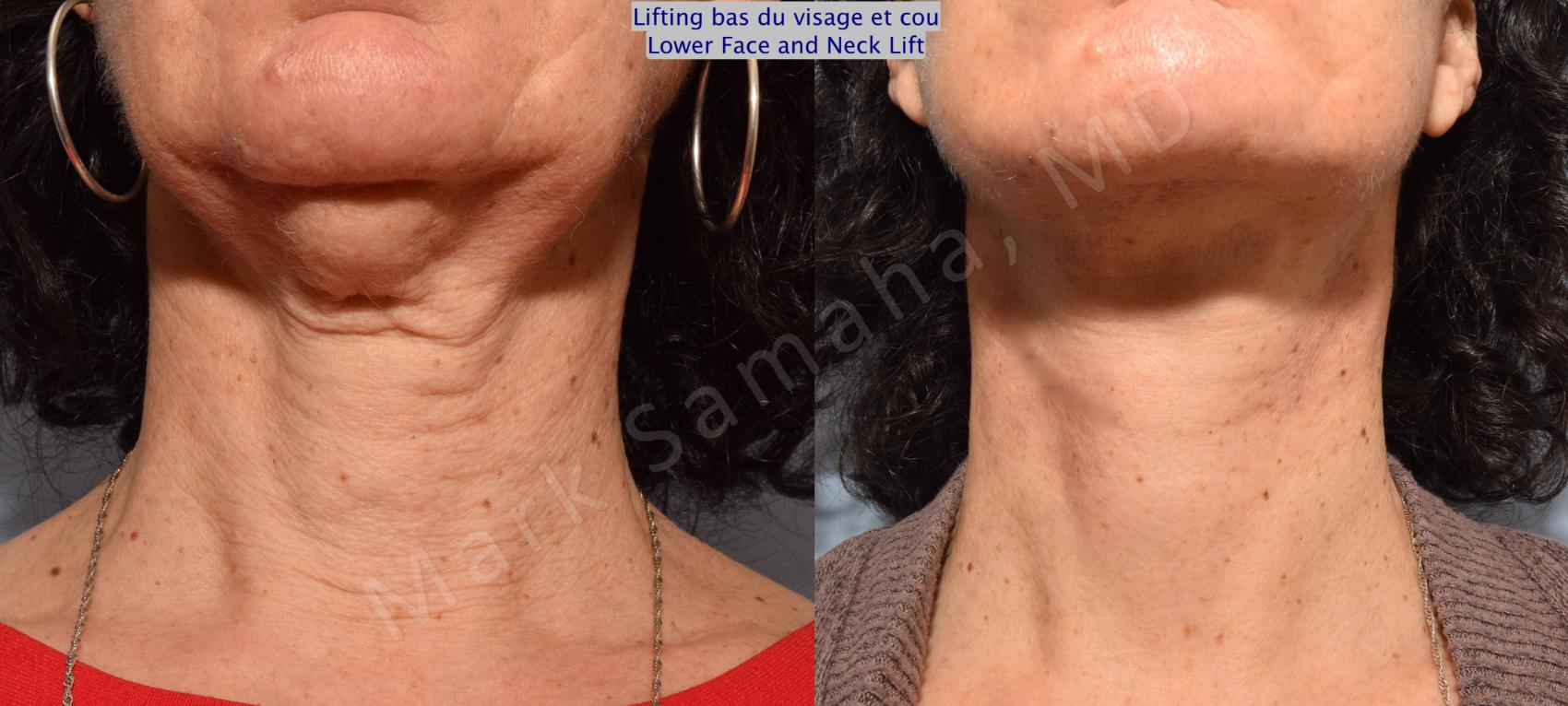Lifting du visage / Cou Facelift / Necklift Avant & Après Photos / Before and After Pictures