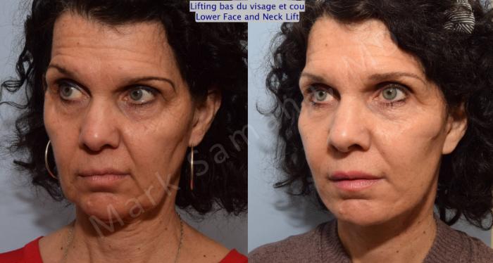 Before & After Lifting du visage / Cou - Facelift / Necklift Case 68 View #5 View in Montreal, QC