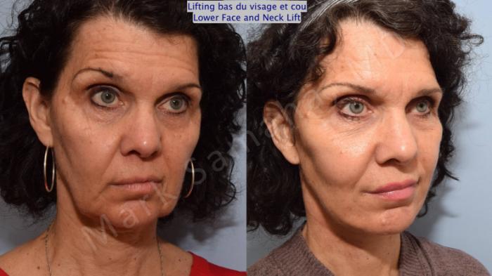 Before & After Lifting du visage / Cou - Facelift / Necklift Case 68 View #6 View in Montreal, QC
