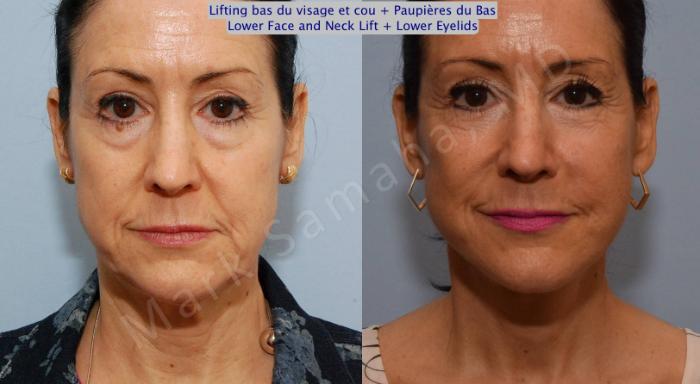 Before & After Blépharoplastie / Blepharoplasty Case 69 View #1 View in Mount Royal, QC