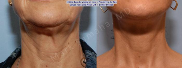 Before & After Lifting du visage / Cou - Facelift / Necklift Case 69 View #2 View in Montreal, QC