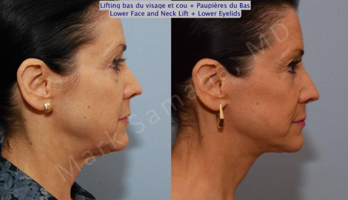 Before & After Lifting du visage / Cou - Facelift / Necklift Case 69 View #4 View in Montreal, QC