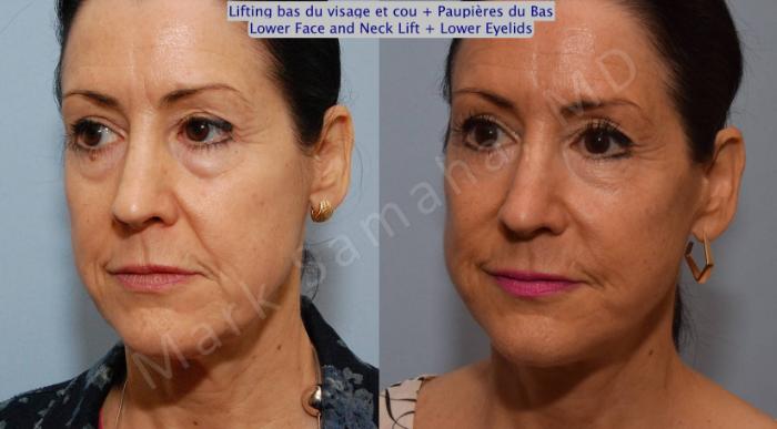 Before & After Lifting du visage / Cou - Facelift / Necklift Case 69 View #5 View in Mount Royal, QC