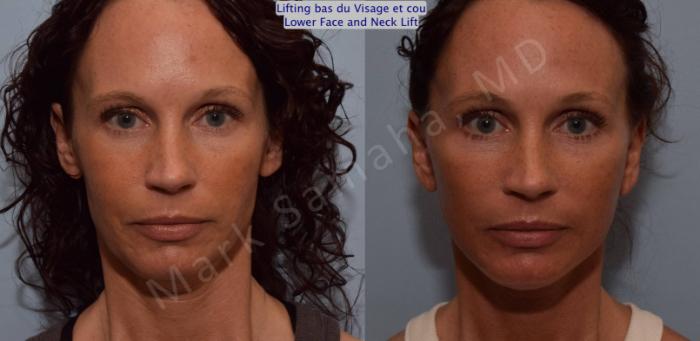 Before & After Lifting du visage / Cou - Facelift / Necklift Case 88 View #1 View in Montreal, QC