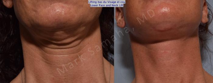 Before & After Lifting du visage / Cou - Facelift / Necklift Case 88 View #2 View in Mount Royal, QC