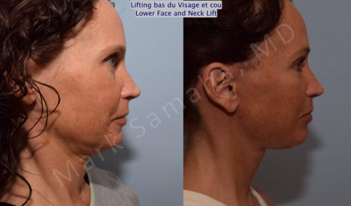 Before & After Lifting du visage / Cou - Facelift / Necklift Case 88 View #4 View in Montreal, QC