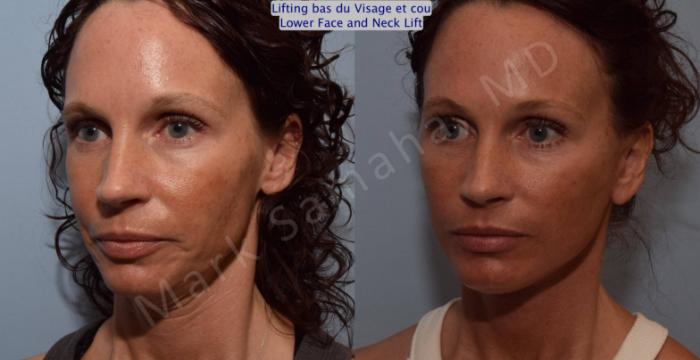 Before & After Lifting du visage / Cou - Facelift / Necklift Case 88 View #5 View in Mount Royal, QC