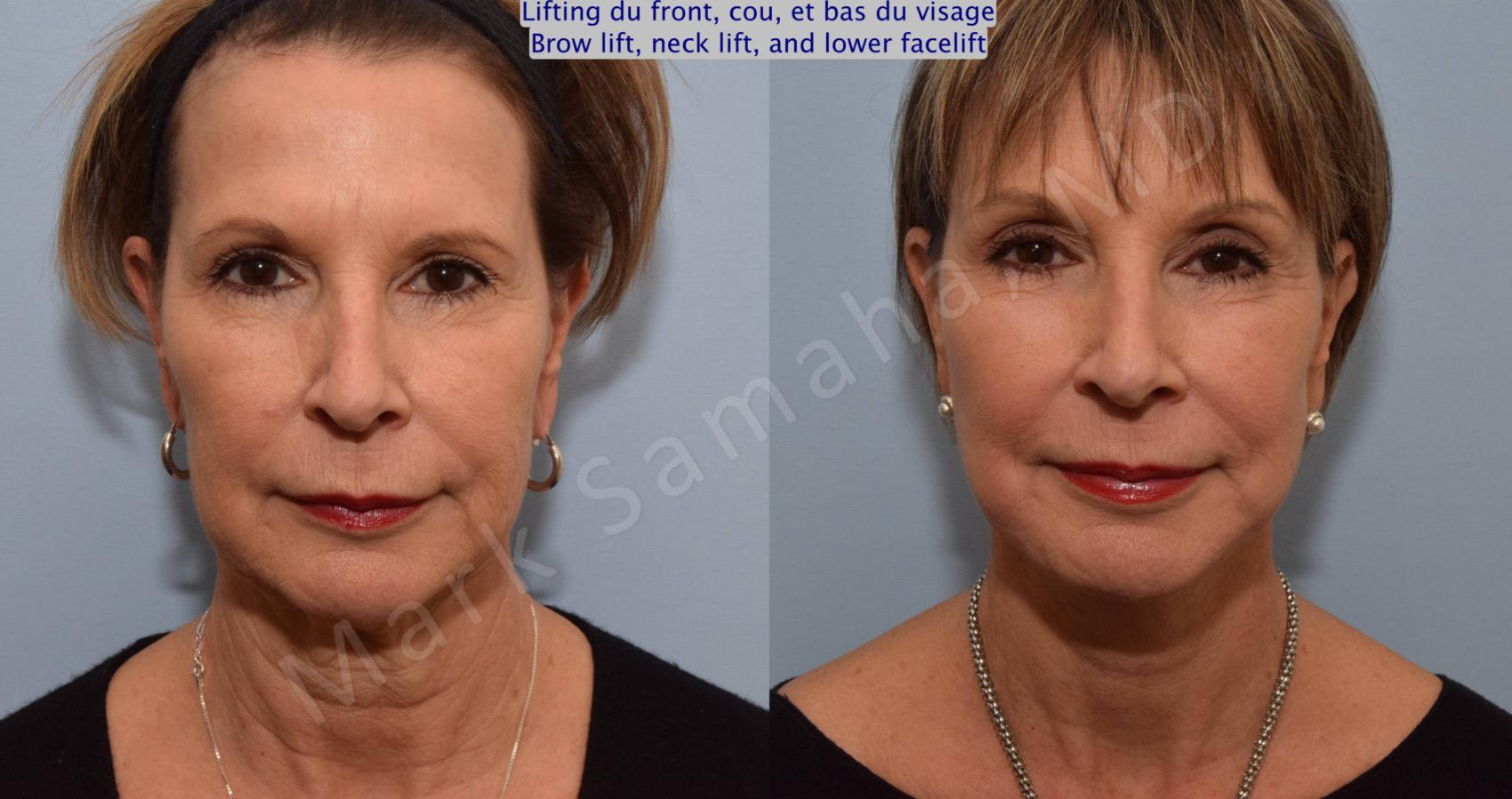 Lifting Du Visage Cou Facelift Necklift Avant Apr S Photos